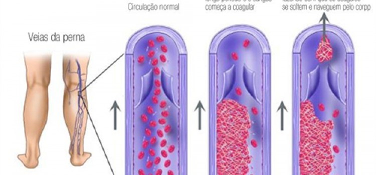 Tudo que você precisa saber sobre a trombose venosa profunda